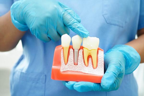 removable aligners adyar conve