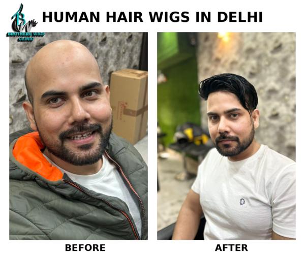 front lace hair patch vikaspur