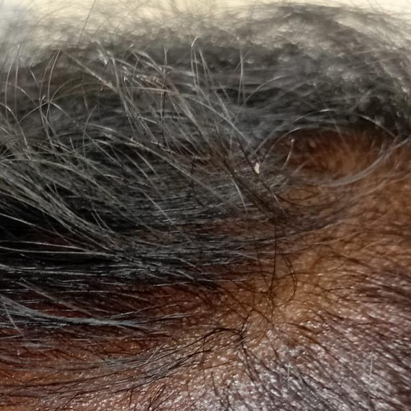 alopecia areata treatment in t