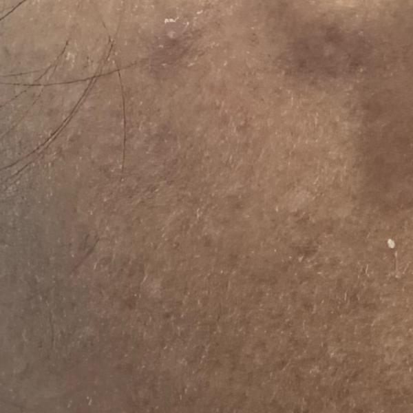 medifacial service in trichy