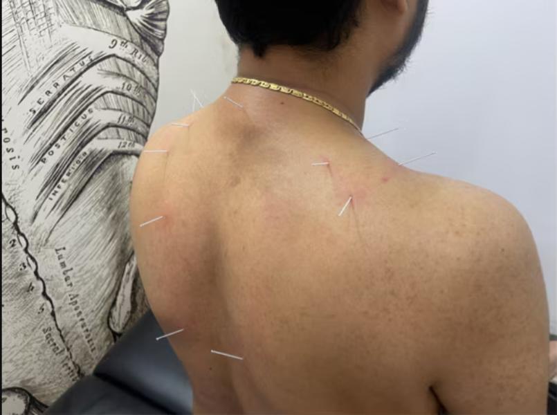 Dry needling has quietly becom