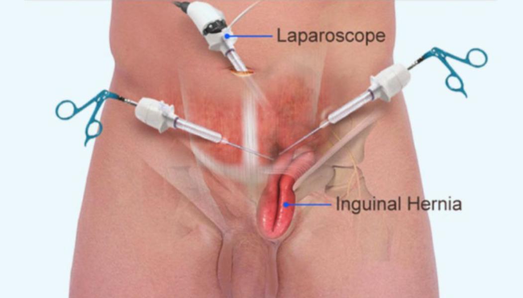 Lap hernial repair addresses a