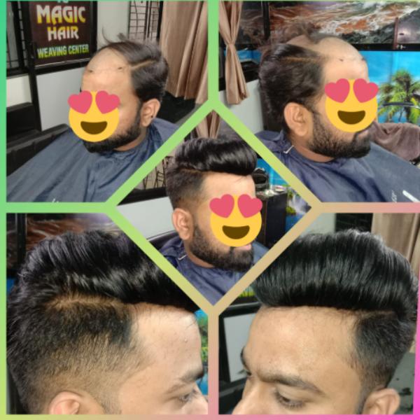 Hair loss can affect people of different