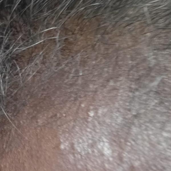 best dermatologist for dandruf