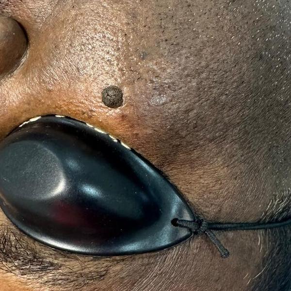 Seborrheic Keratosis on the Fa