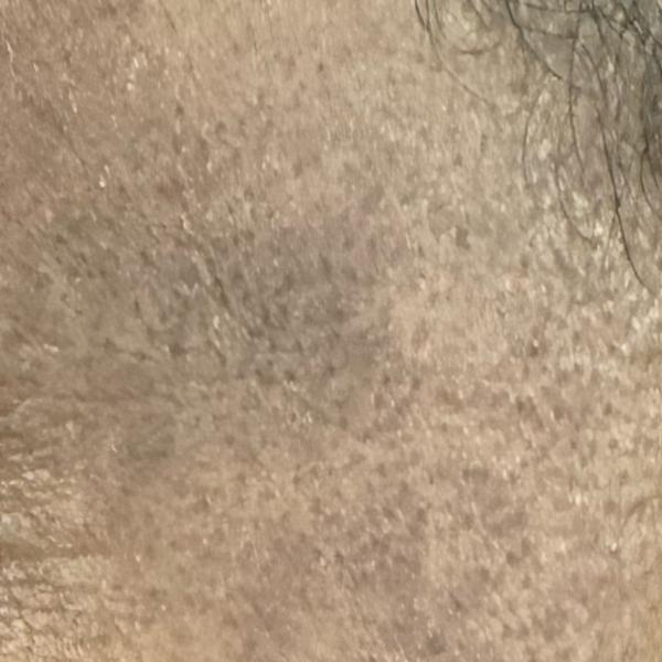 best medi facial service thill