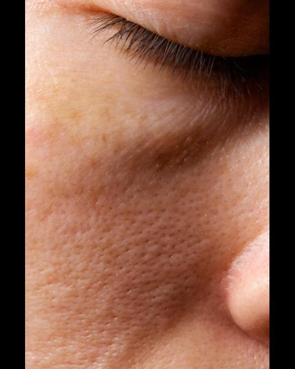 Open Pores Treatment is a comm