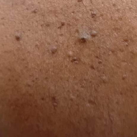 wart removal near me