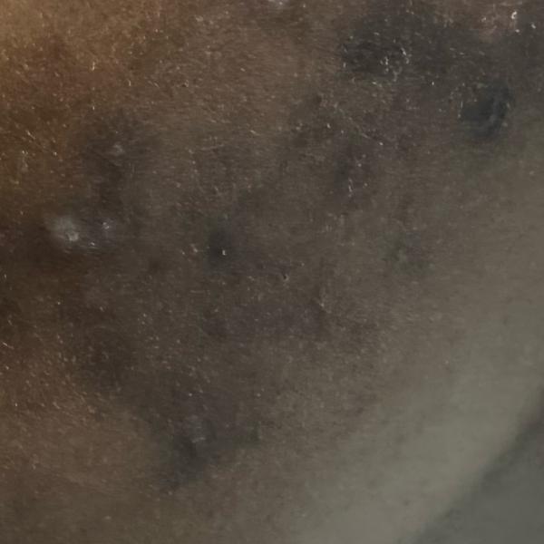 top acne treatment thillai nag