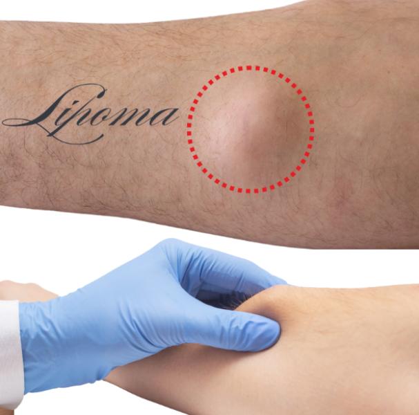 Lipoma Rem