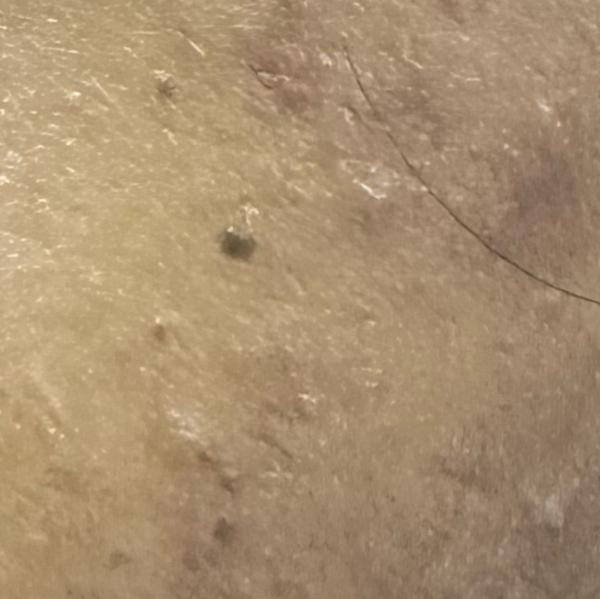 wart removal treatment thillai