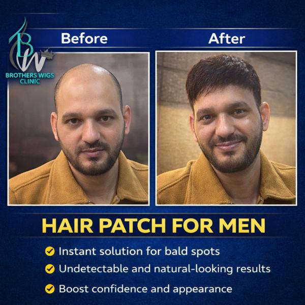 Hair Patch In Delhi NCR | Best