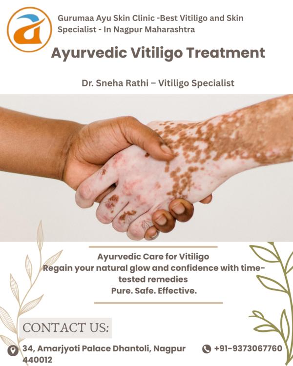 Expert Vitiligo Treatment by Dr. Sneha RathiSay 