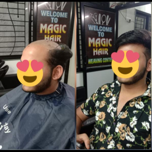 Hair loss is a common concern among men 