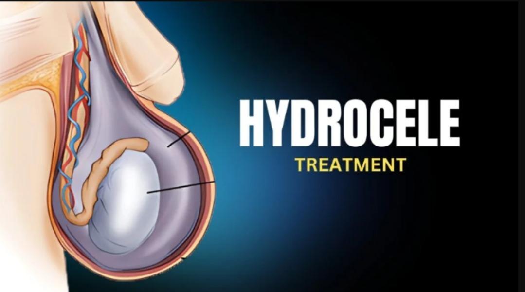 Hydrocele surgery treats a con