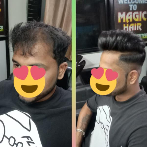 Advanced hair restoration techniques hav