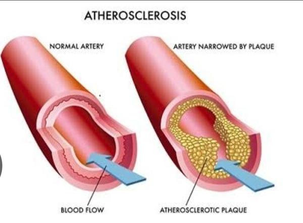 Lipid Profile Test in Rohini, 