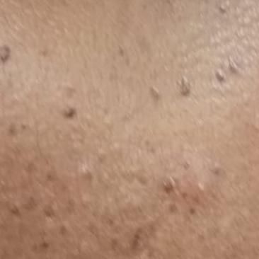 skin tag removal expert in thi