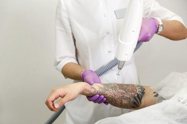 Tattoo Removal Treatment is of