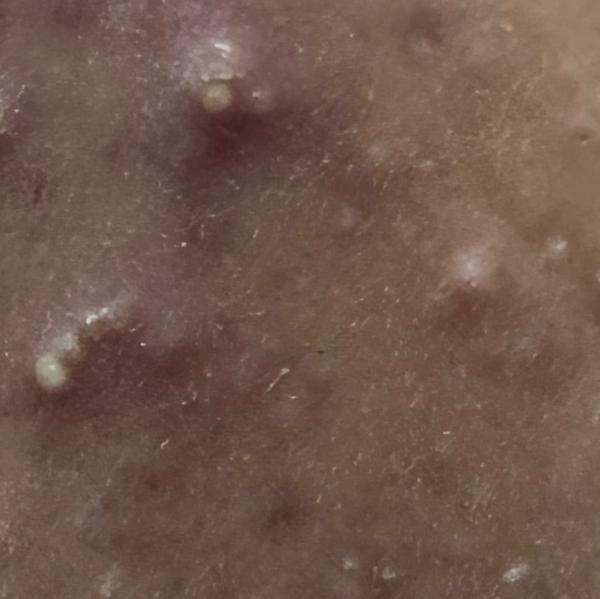 hydra facial service in thilla