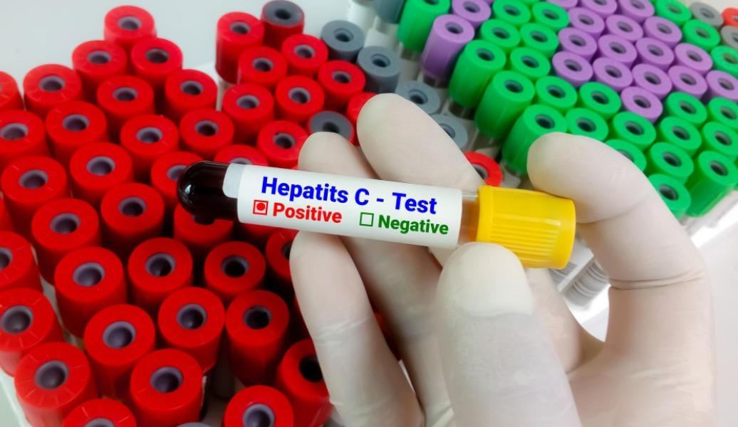 Hepatitis C is a viral infecti