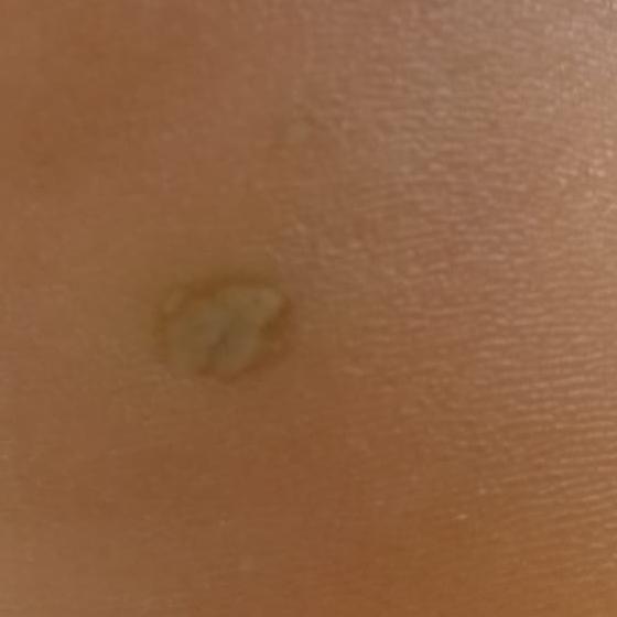 top wart removal trichy woraiy