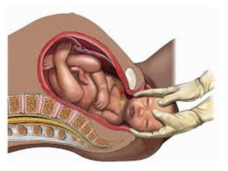 Normal delivery is often seen