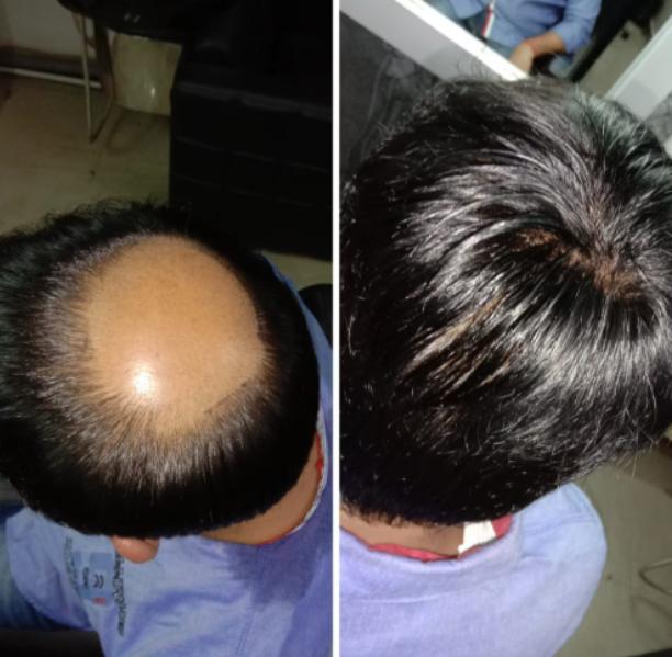 Hair restoration methods today focus on 