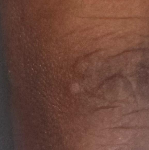 mole removal trichy dermatolog