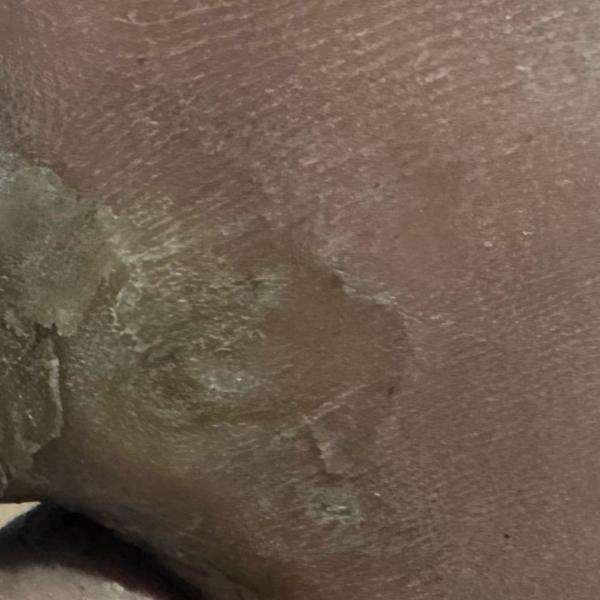 affordable wart removal thilla