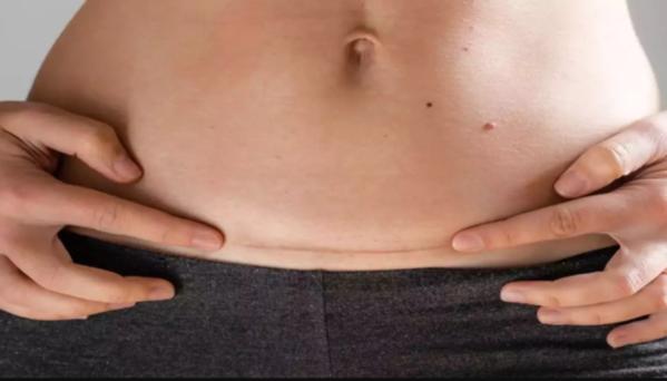 LSCS, or cesarean delivery, is