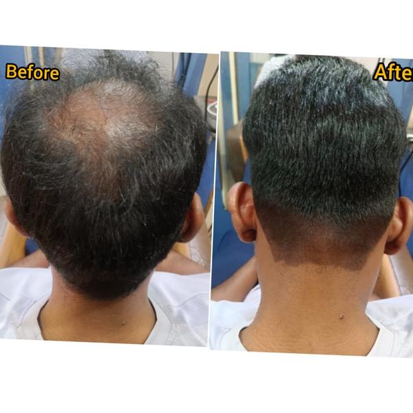 Advanced hair restoration techniques hav