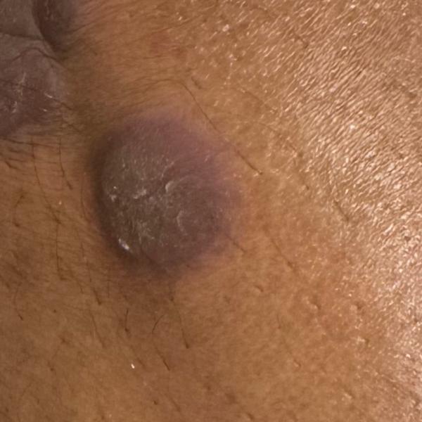 Dr.s.Valarmathi, a skin doctor