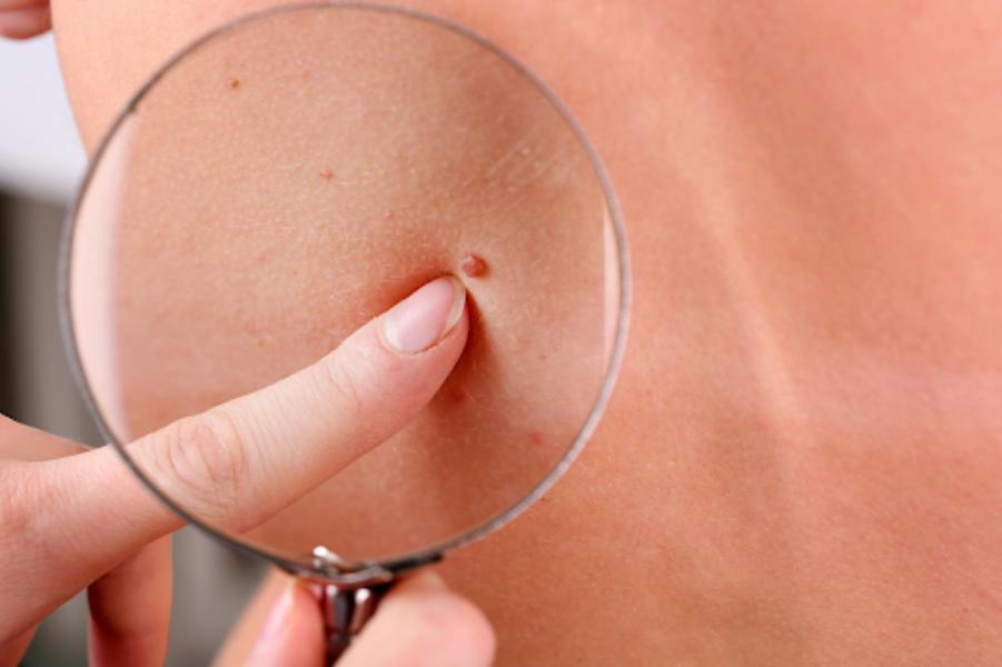 safe removal methods skin tags