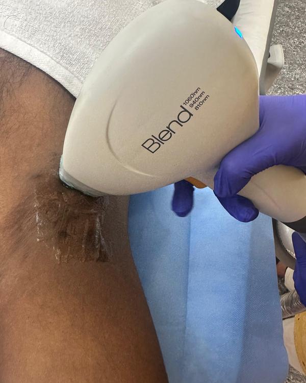 Discover how laser hair reduct