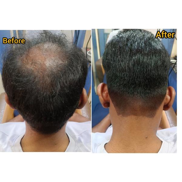 Hair restoration method today focus on a