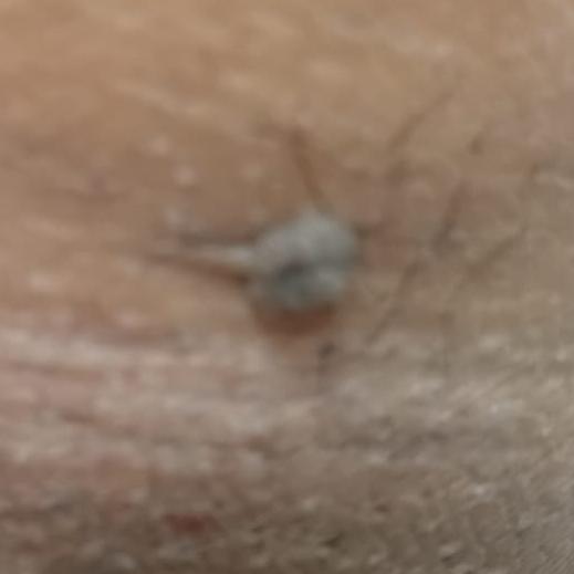 affordable wart removal thilla