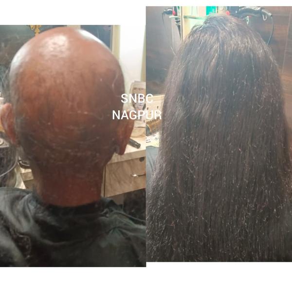 Worried about thinning hair or bond patc