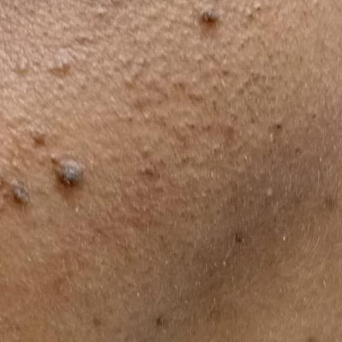 affordable wart removal thilla