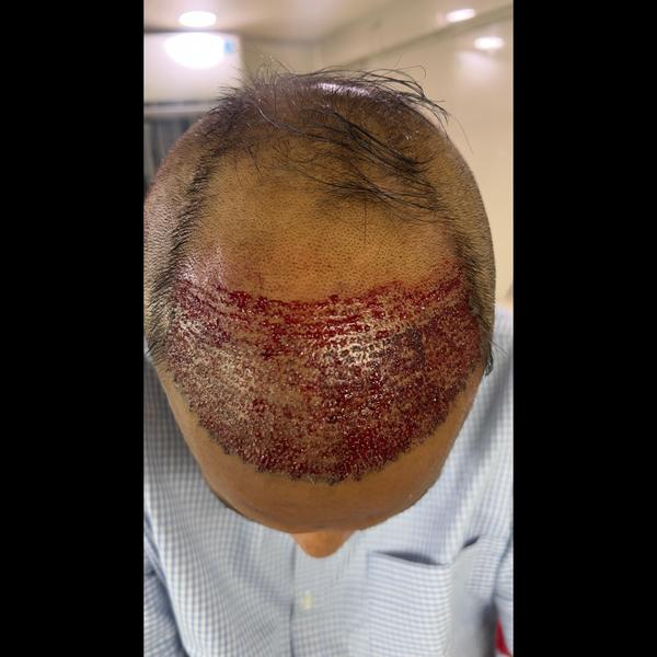 Hair Transplant in Nagpur vs Other India