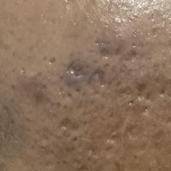 acne treatment center in thill