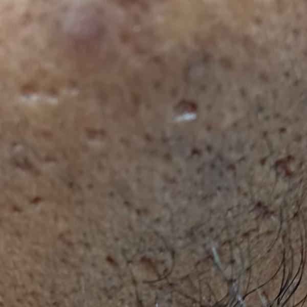 pigmentation treatment center