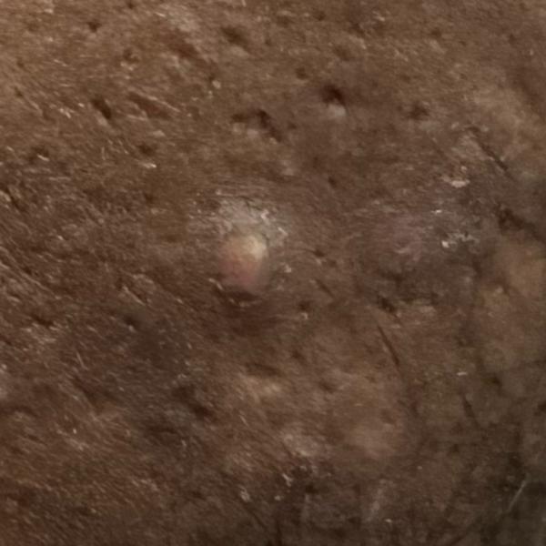 acne treatment in woraiyur