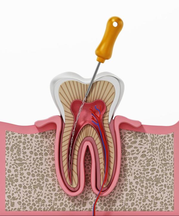 Root Canal Treatment often sou