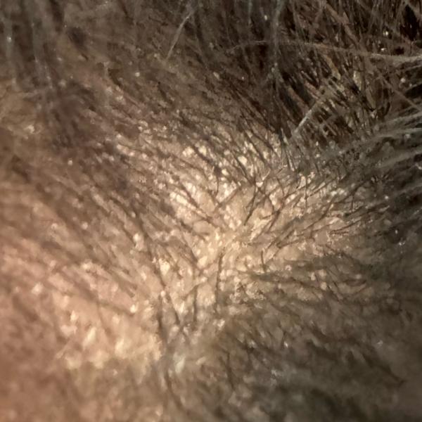 Dr.s.Valarmathi, the best derm