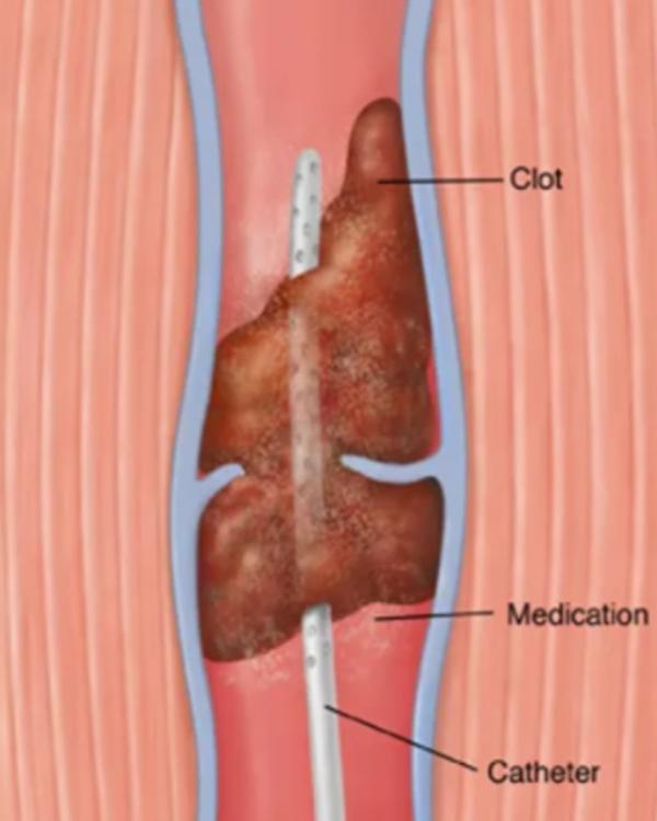Thrombolysis is a critical tre