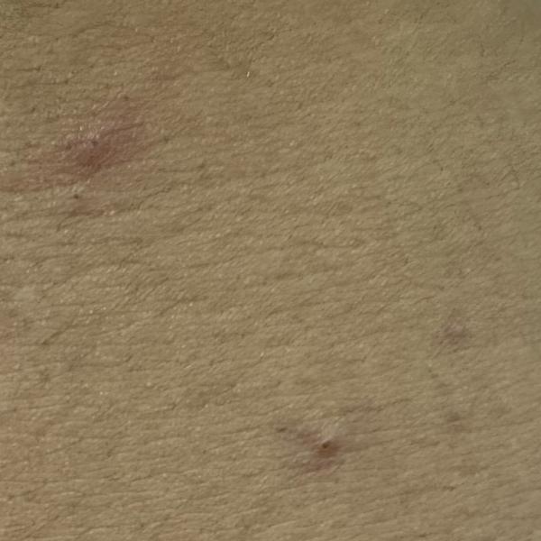 Dr.s.Valarmathi, a skin doctor