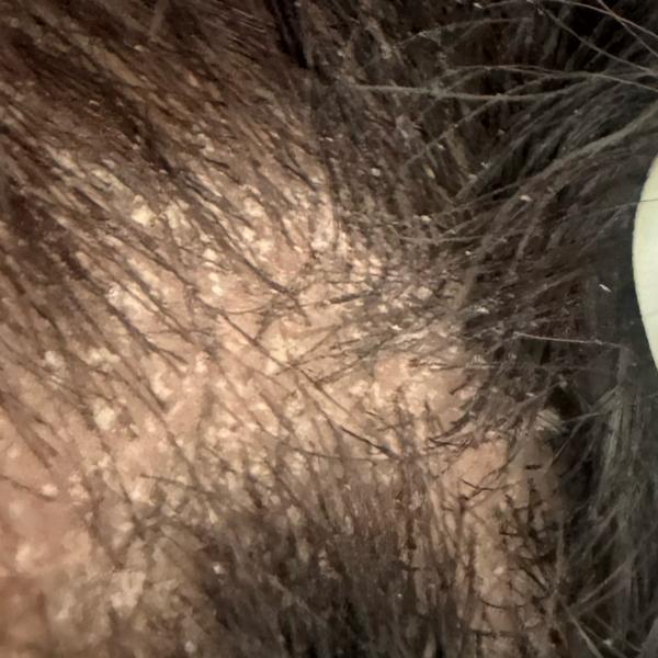 Dr.s.Valarmathi, a dermatologi