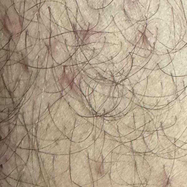 Dr.s.Valarmathi, a skin doctor