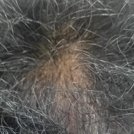 Dr.S.Valarmathi, a skin doctor